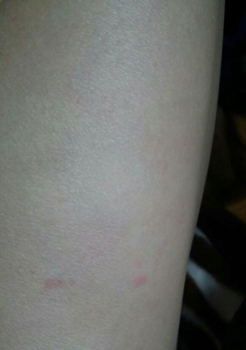 为什么狗狗要咬自己的腿?(探究狗狗咬腿行为的原因和解决方法) 为什么狗狗要咬自己的腿?(探究狗狗咬腿行为的原因和解决方法)