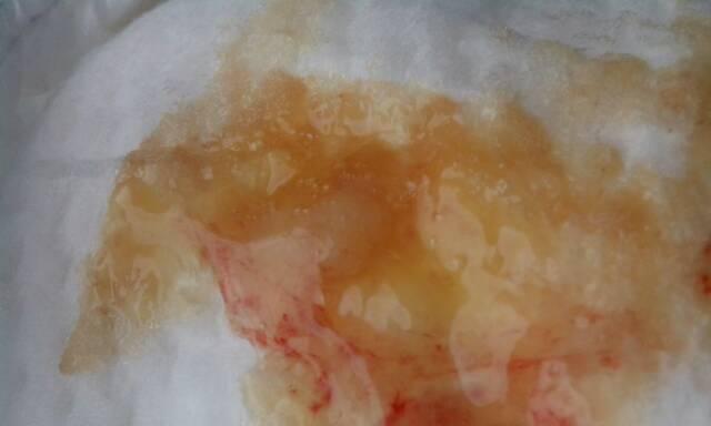 尿中出现血迹，你需要了解的原因和应对方法