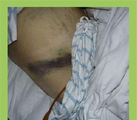 胰头炎症状及预防治疗方法