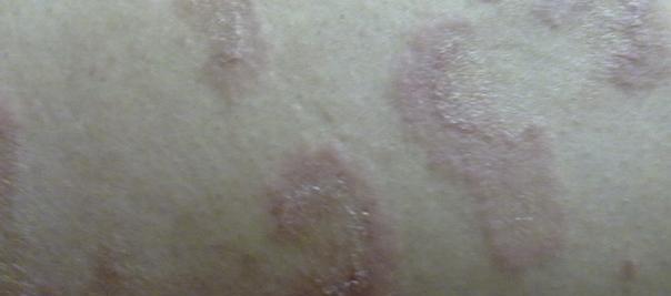 探索英斗皮肤病的原因和治疗方法（了解英斗皮肤病的类型和症状，找到有效的治疗方法）