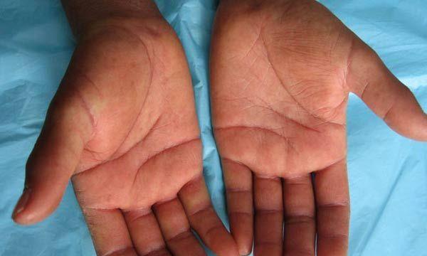 英斗皮肤病原因与治疗全解析