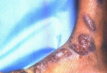 揭秘脓皮症的成因与治疗方法（探究脓皮症的症状、危害与预防方法）