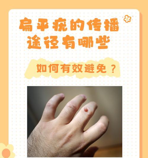 人类疾病传染（传染病的爆发和预防措施）