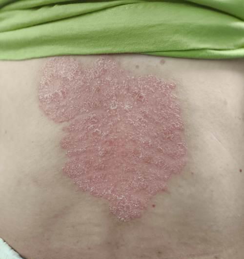 常见的传染性皮肤病有哪些?(了解传染性皮肤病,预防传播才能更有效) 常见的传染性皮肤病有哪些?(了解传染性皮肤病,预防传播才能更有效)