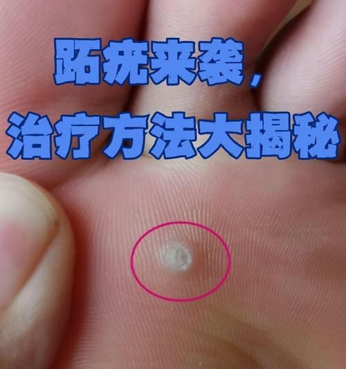 常见的传染性皮肤病有哪些?(了解传染性皮肤病,预防传播才能更有效) 常见的传染性皮肤病有哪些?(了解传染性皮肤病,预防传播才能更有效)