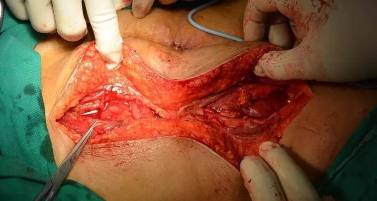 狗肠梗阻手术（了解狗肠梗阻手术后的恢复时间以及关键因素，让你的宠物更快康复）