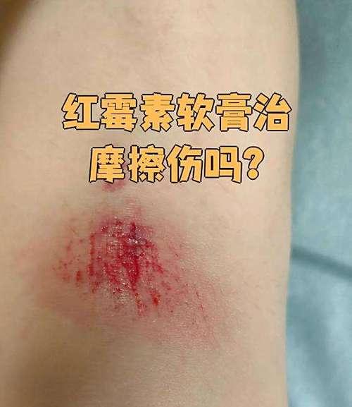 皮肤擦伤发炎应对指南（急救小知识，有效防范皮肤擦伤后的感染风险）